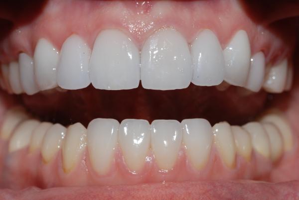 Коронка на зуб фото до и после