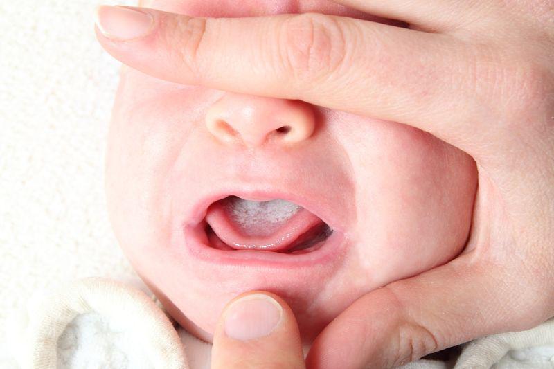 Белый налет в горле у ребенка фото